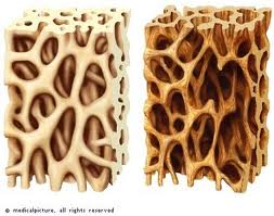 osteoporosis gum disease ff60f